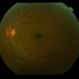 Normal Eye Normal Eye